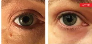 Fotona official SmoothEye Clinical Results case 4, follow-up image; illustrative only, not a Dr Tam patient result